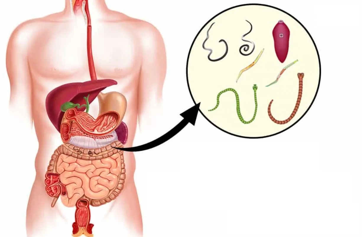 Life Cycle of Enterobiasis: Complete Guide to Pinworm Infection, Symptoms, Treatment, and Prevention